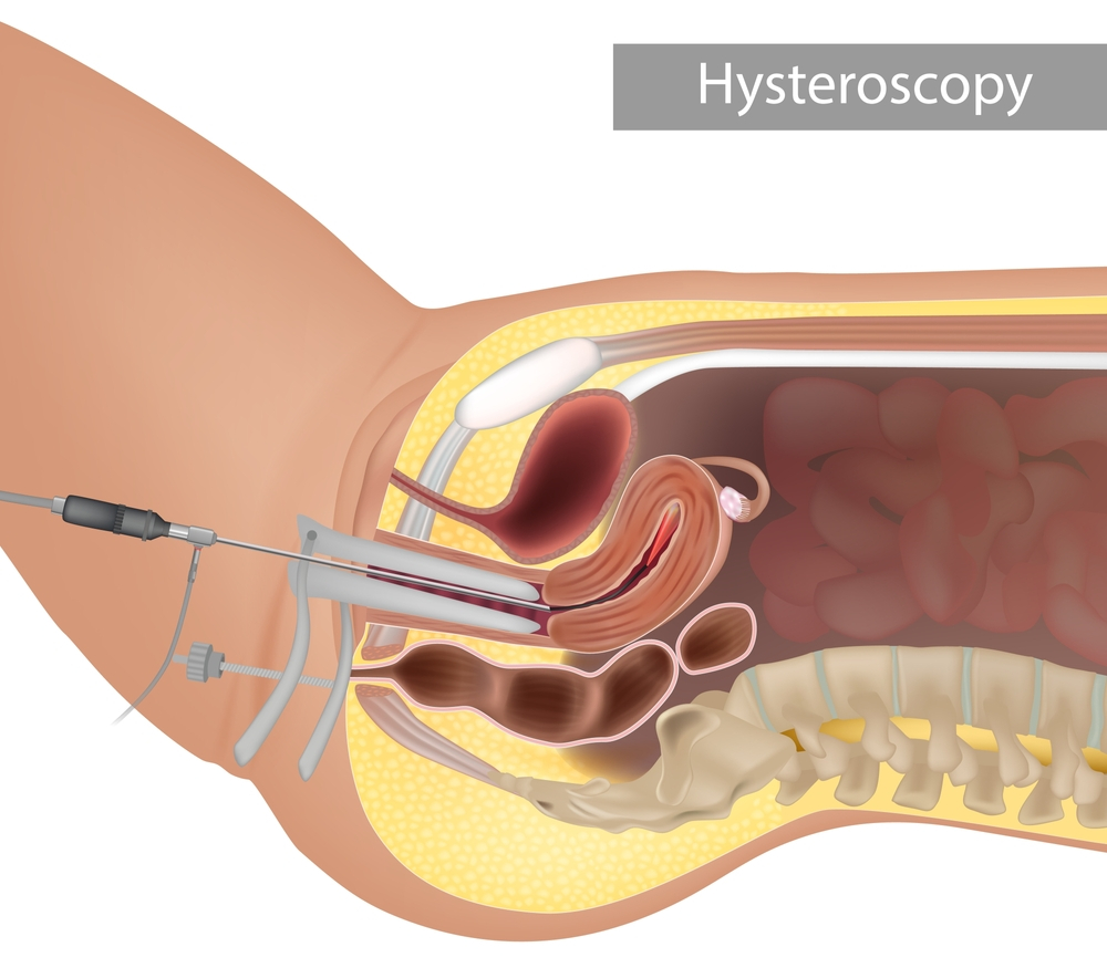 Hysteroscopy