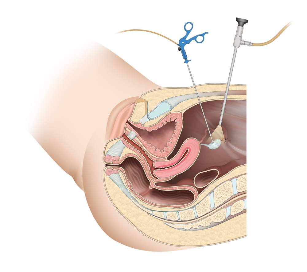 Laparoscopy