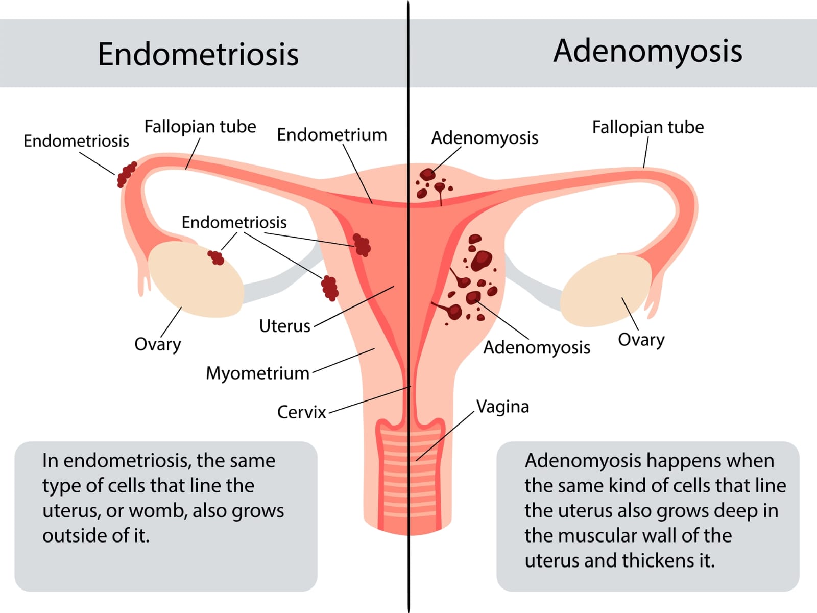 Endometriosis & Adenomyosis