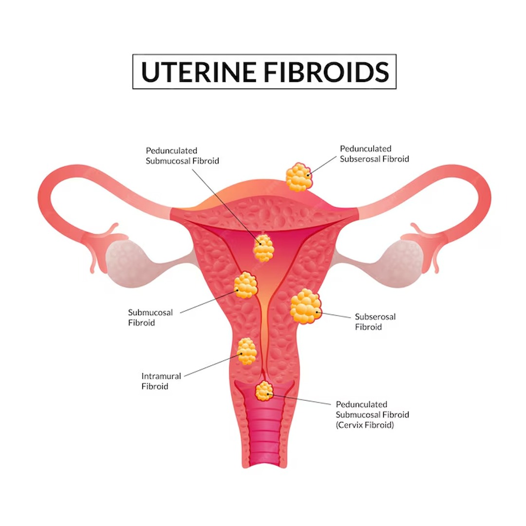 Uterine Fibroid