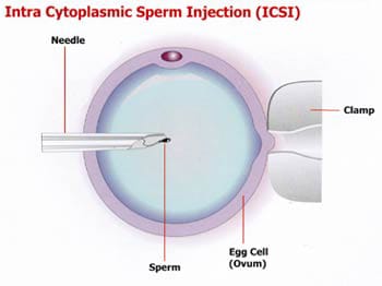 ICSI Treatment