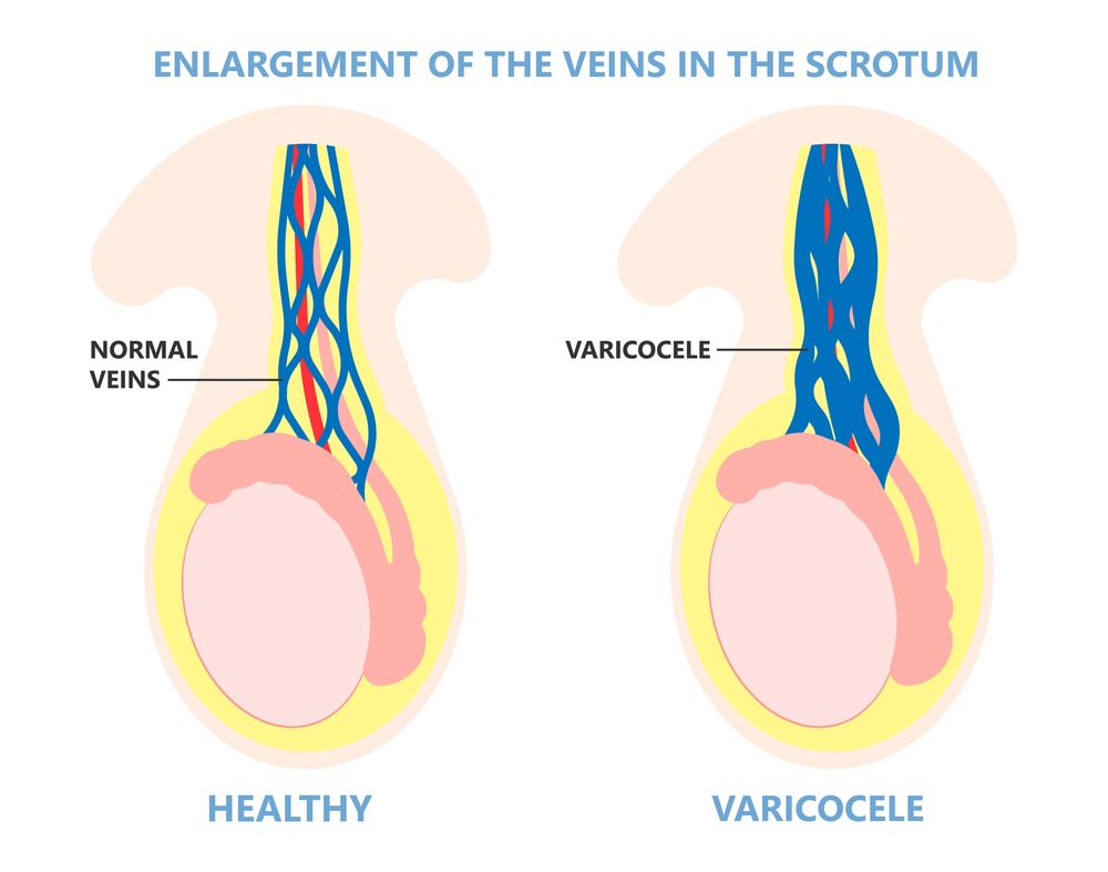Varicocele Treatment